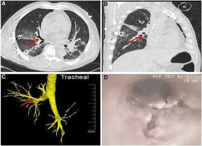 Case report: Incomplete laceration of the right middle lobar bronchus due to blunt chest trauma: An unusual pattern and attentions